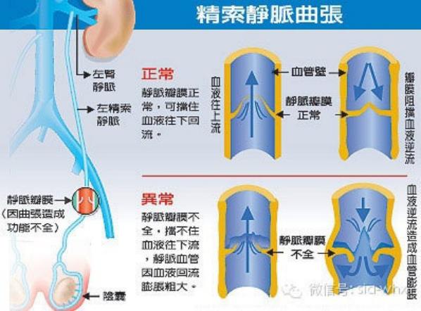 關于2021年征兵精索靜脈曲張標準的探討，2021年征兵精索靜脈曲張標準深度解析
