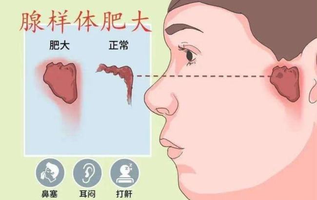 腺樣體肥大能自愈嗎？——深度解析與理解，腺樣體肥大能否自愈？全面深度解析