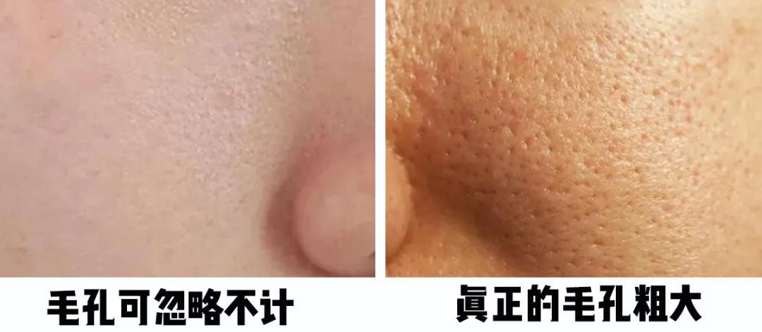 怎樣毛孔可以慢慢縮小，護膚秘籍與實用建議，護膚秘籍，縮小毛孔實用建議與指南