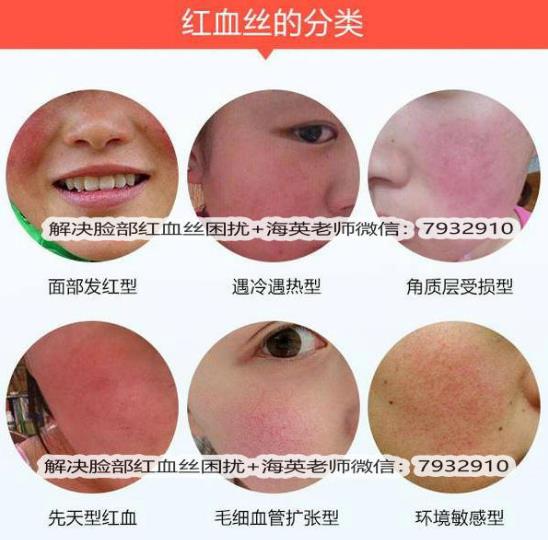 臉上出現(xiàn)紅血絲怎么治療，全面解析有效方法，臉上紅血絲全面解析與有效治療方法