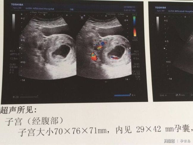 有卵黃囊基本就穩(wěn)了，早期妊娠的穩(wěn)固跡象與注意事項(xiàng)，早期妊娠的穩(wěn)固跡象，卵黃囊出現(xiàn)后的穩(wěn)定與注意事項(xiàng)