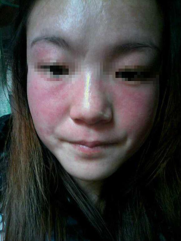 如何去掉黃褐斑的最好辦法，如何有效去除黃褐斑的方法探究