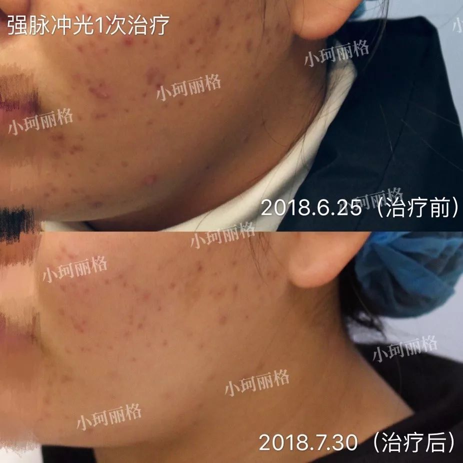粉刺痤瘡怎樣徹底治愈，全面解析與有效方法，粉刺痤瘡全面解析，如何徹底治愈與有效防治方法