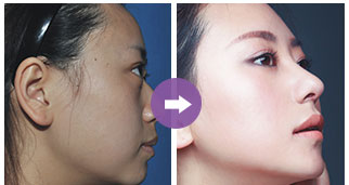 關(guān)于只做鼻翼縮小手術(shù)的費用分析，只做鼻翼縮小手術(shù)的費用詳解