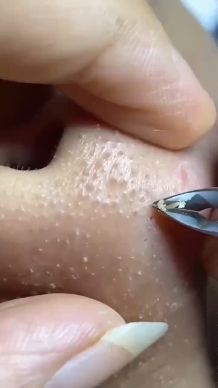 如何有效處理黑頭問題——全方位解析黑頭成因與解決方案，全方位解析，黑頭成因探究與有效處理方案