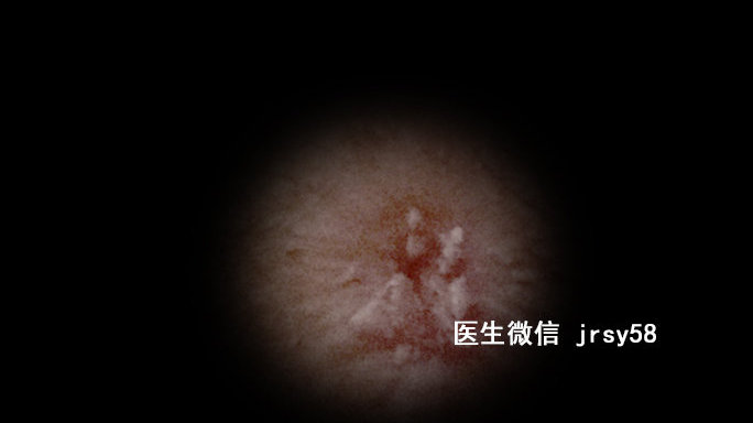 尖銳濕疹，深入了解與治療建議，尖銳濕疹，深度解析與治療指南