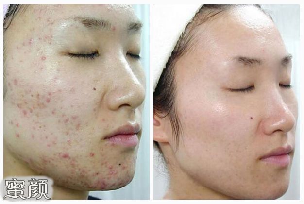 如何祛痘消除痘印——你的肌膚完美指南，完美肌膚指南，祛痘與消除痘印的方法