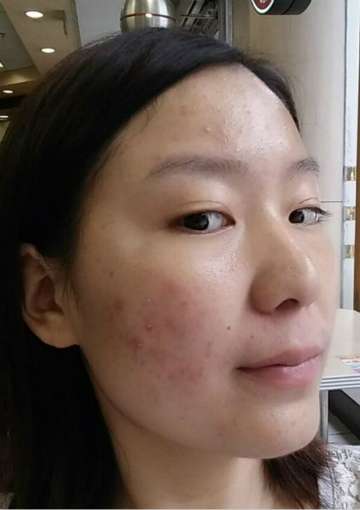如何有效去除臉上痘痘——多種方法助您重拾肌膚光彩，多種方法助您有效去除臉部痘痘，重拾肌膚光彩