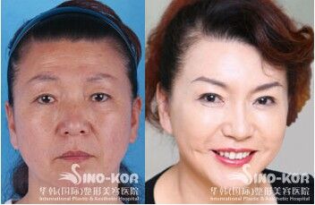 美容去皺紋針的價格，了解一針的價格及更多細節(jié)，美容去皺針價格解析，一針的價格及更多細節(jié)揭秘