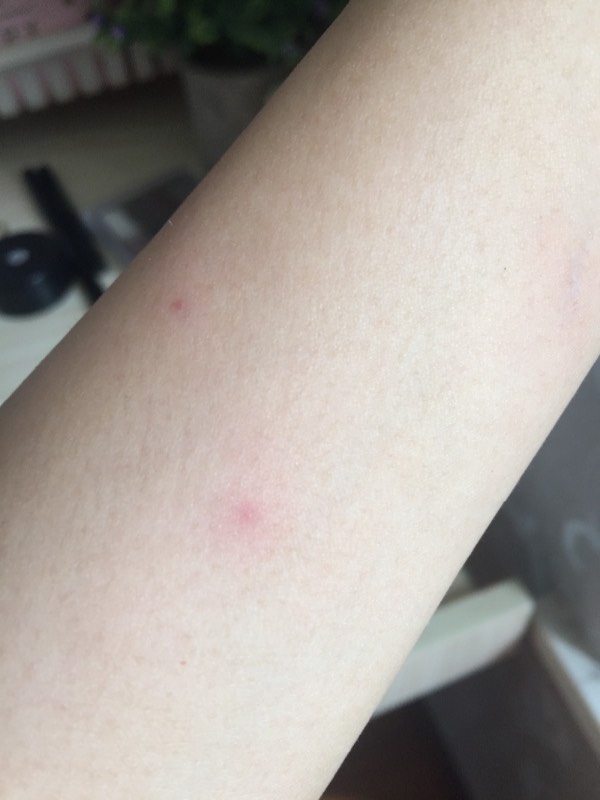 身上紅點不痛不癢圖片，原因、識別與處理方法，身上紅點無痛癢，識別、原因及處理方法