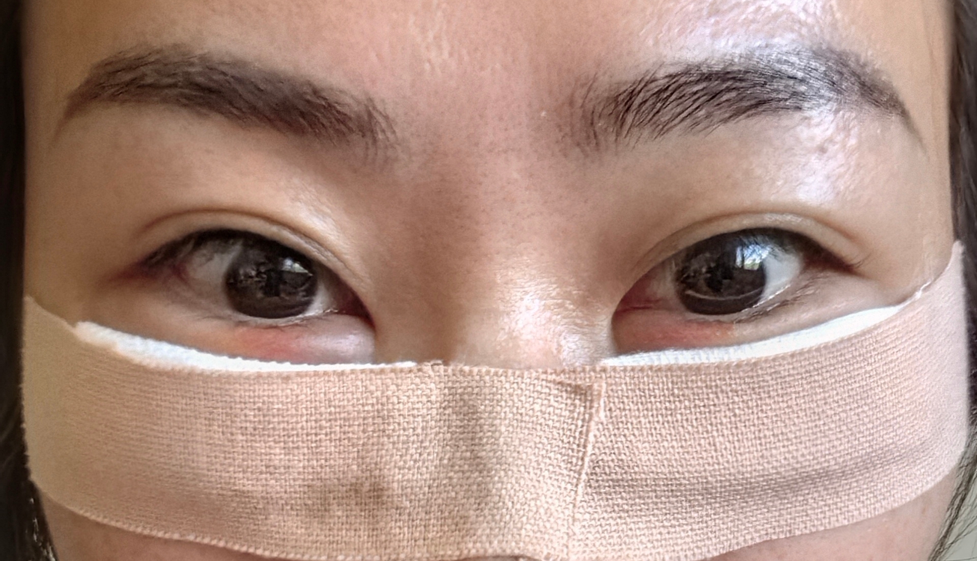 眼袋手術，重塑眼部魅力，重拾自信光彩，眼袋手術重塑眼部魅力，重拾自信亮眼光彩