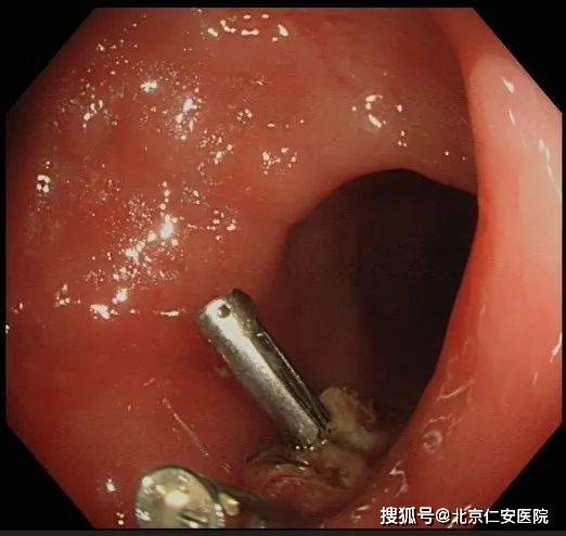 胃腸鏡檢查后悔死了？了解真相，消除疑慮，揭秘胃腸鏡檢查真相，消除疑慮，避免后悔！