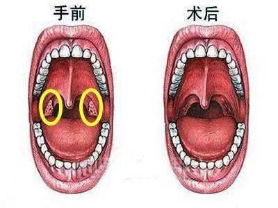 如何應(yīng)對扁桃體發(fā)炎引起的喉嚨腫痛？，如何應(yīng)對扁桃體炎引起的喉嚨腫痛？有效緩解方法與建議。