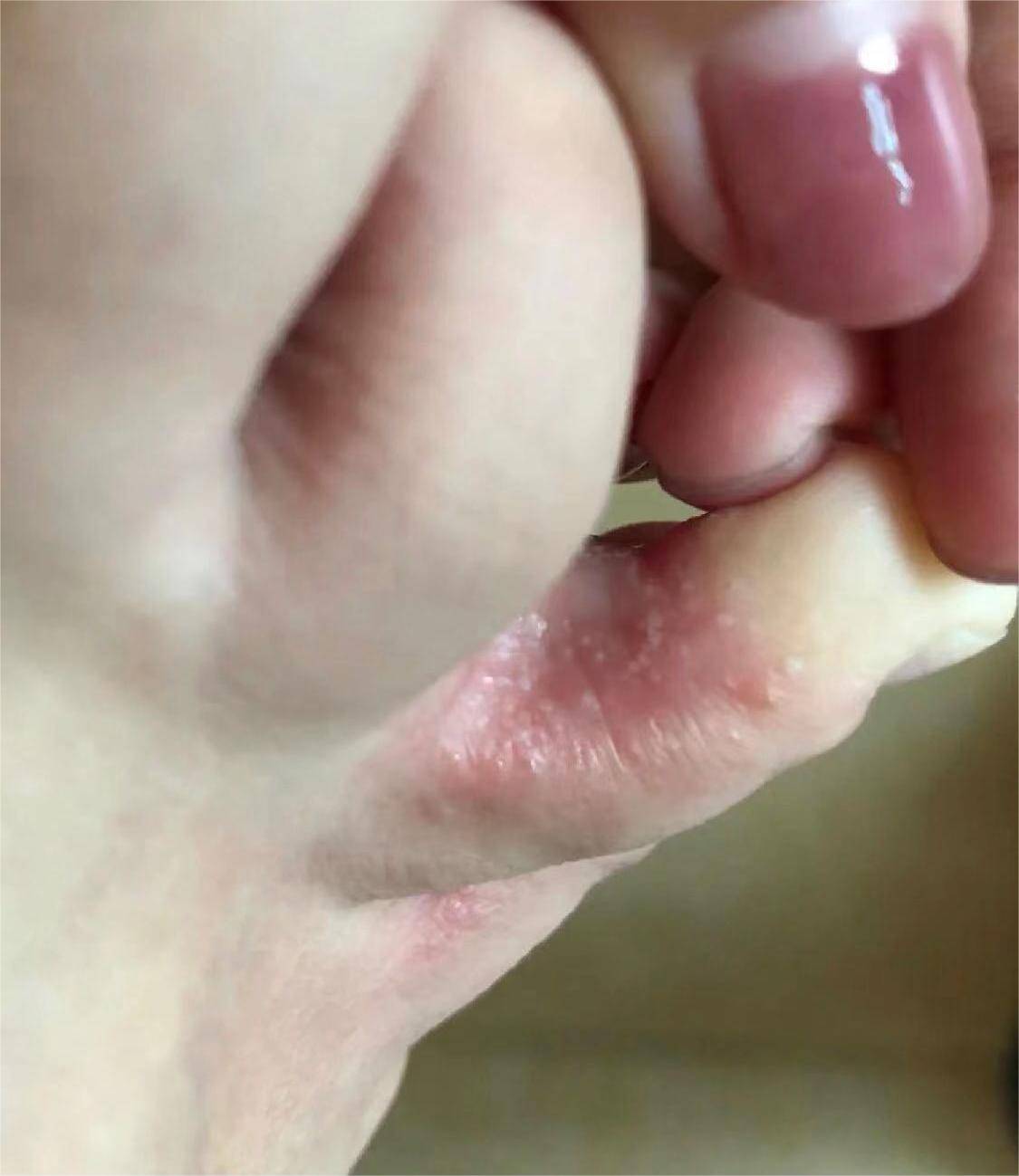 腳氣爛腳趾縫癢潰爛的治療方法，全面解析與有效策略，腳氣爛腳趾縫癢潰爛全面解析與治療方法探討