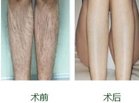 激光脫毛，價(jià)格因素詳解，激光脫毛詳解，價(jià)格因素剖析