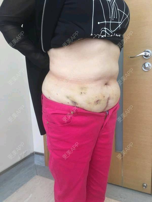 腰腹吸脂后1到7天恢復過程圖片展示，腰腹吸脂術后恢復過程圖片展示（1-7天）
