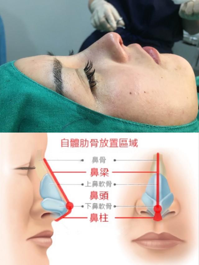 鼻綜合整形項(xiàng)目詳解，包括哪些項(xiàng)目？，鼻綜合整形項(xiàng)目詳解，涵蓋內(nèi)容與整形項(xiàng)目概覽