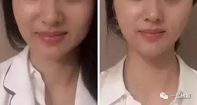 瘦臉針打三次就可以永久定型了嗎？深度解析瘦臉針效果與注意事項(xiàng)，深度解析，瘦臉針效果及注意事項(xiàng)——打三次能否永久定型？