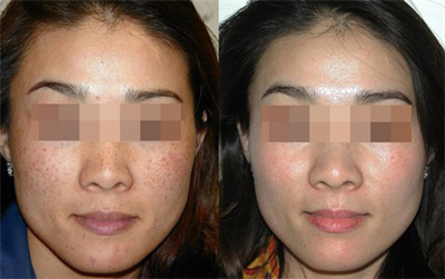 如何有效去除黃褐斑，全面解析黃褐斑成因與解決方案，全面解析黃褐斑成因及有效去除黃褐斑方法