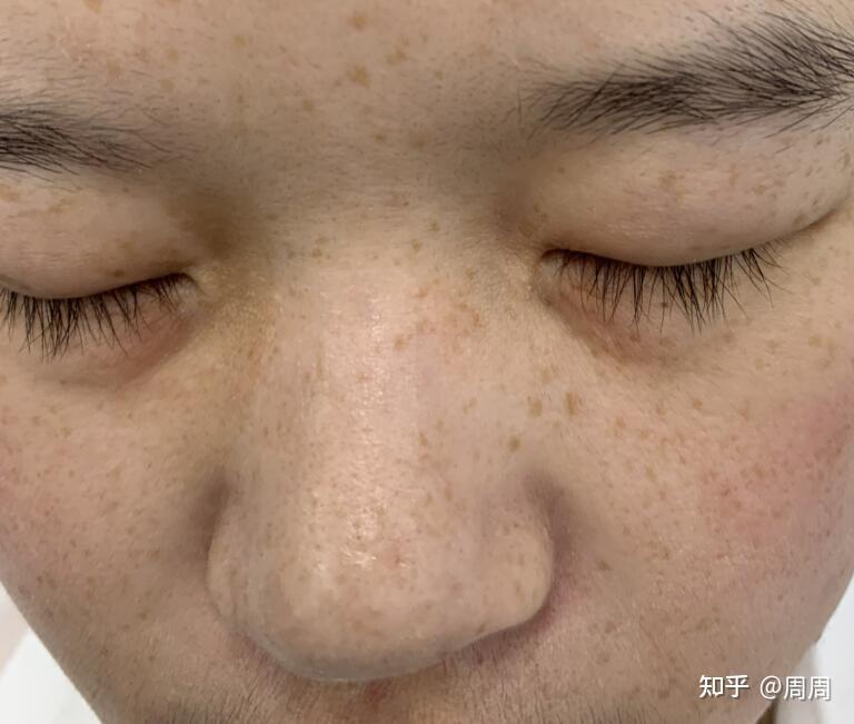 如何淡化雀斑最有效，綜合方法與日常護理，如何有效淡化雀斑，綜合方法與日常護理全解析