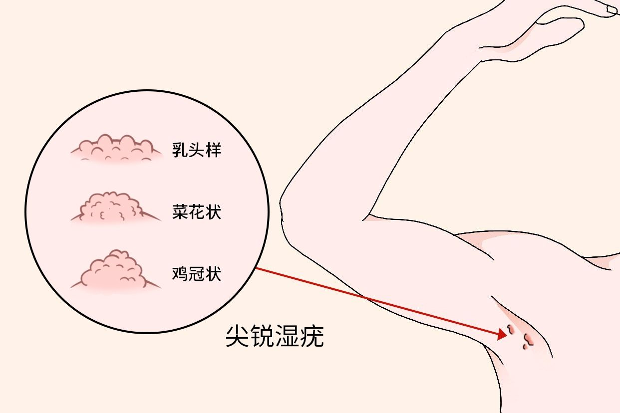 尖銳濕疣圖片，了解、識別與防治，尖銳濕疣圖片詳解，識別、防治全攻略