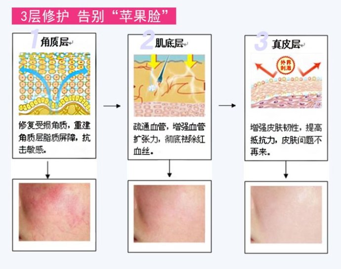 治療紅血絲的最佳方法，治療紅血絲的最佳方法簡述