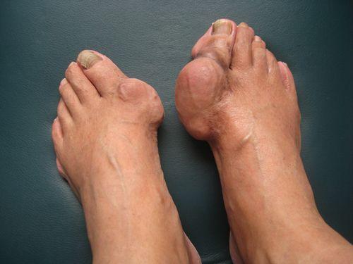 尿酸高最快的恢復(fù)方法，全面解析與行動指南，尿酸高患者必看，全面解析與行動指南，快速恢復(fù)健康之道