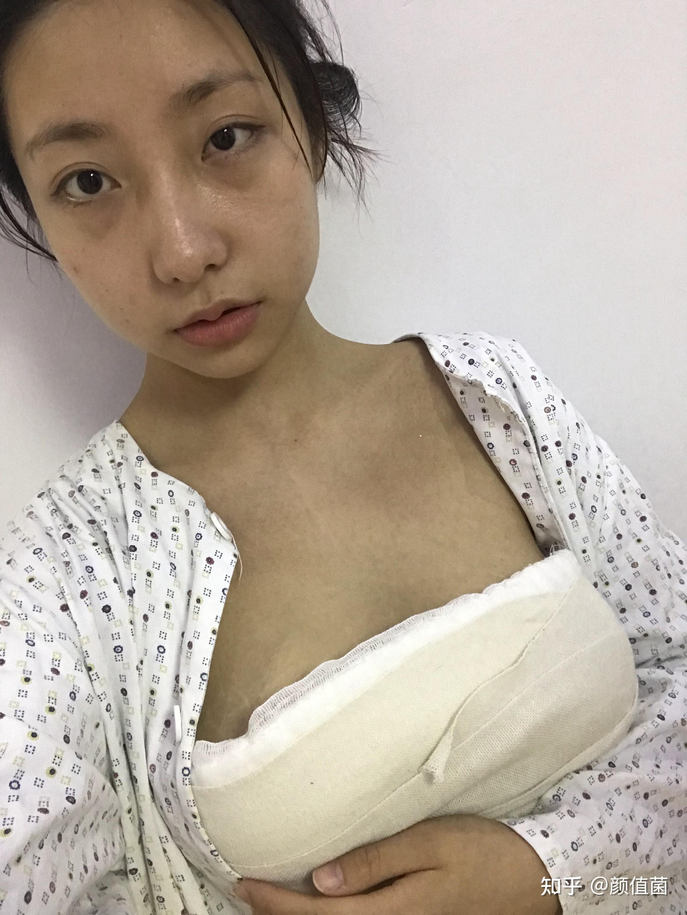 自體脂肪隆胸的真實經(jīng)歷分享，自體脂肪隆胸的真實體驗分享