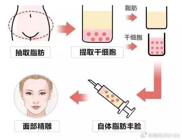 面部脂肪填充效果持久性解析，能保持幾年？，面部脂肪填充效果的持久性解析，能維持多少年？