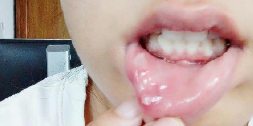 口腔潰瘍最快自愈方法，自然恢復(fù)與預(yù)防策略，口腔潰瘍自然恢復(fù)與預(yù)防策略，快速自愈方法及日常預(yù)防建議