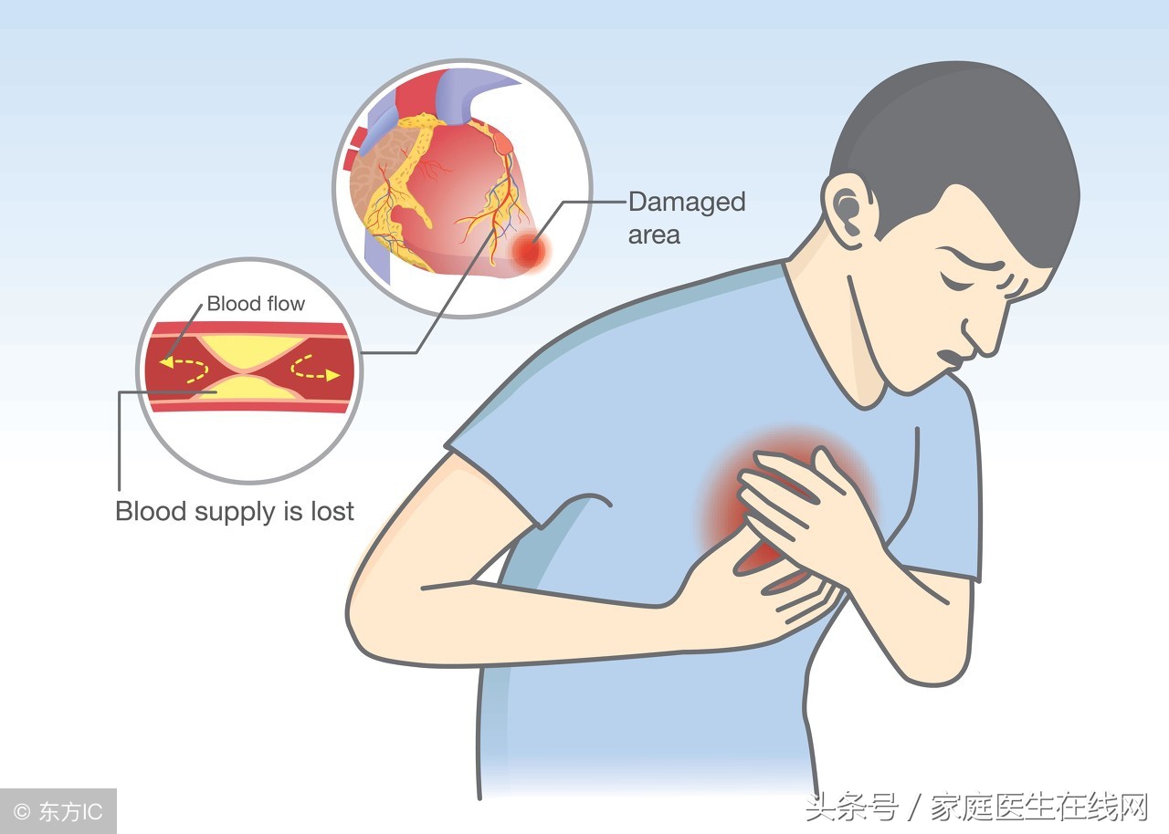 心肌梗塞的最佳治療方法，心肌梗塞的最佳治療方法解析