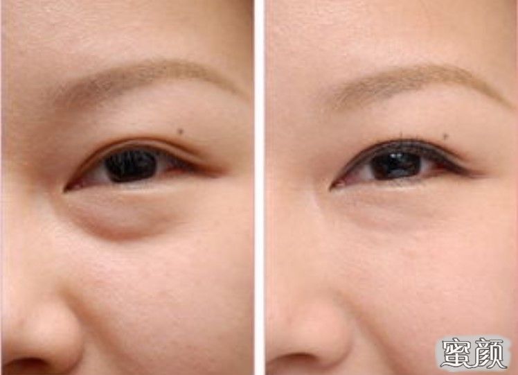 如何消除眼袋，簡(jiǎn)單實(shí)用的方法，消除眼袋的實(shí)用方法與技巧