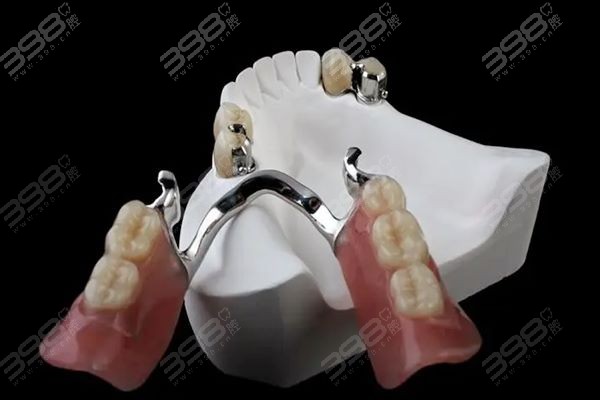 鑲一顆牙大概需要多少錢——全面解析鑲牙費(fèi)用因素，鑲一顆牙的費(fèi)用解析，全面探討鑲牙費(fèi)用因素及大概價(jià)格