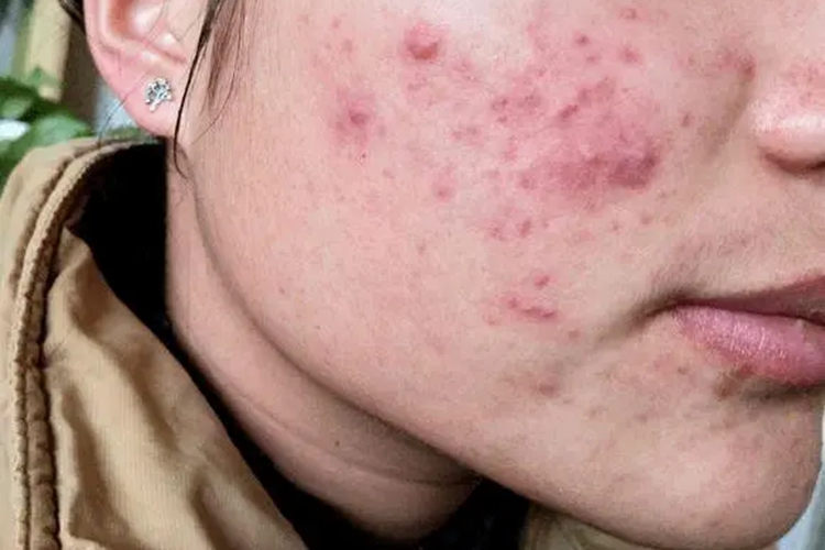 臉上痤瘡的癥狀和圖片，全面解析與識別指南，全面解析與識別，臉上痤瘡的癥狀和圖片指南