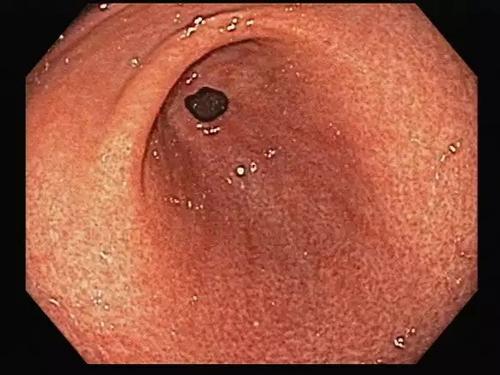 淺表性胃炎的癥狀及其影響，了解、預防與治療，淺表性胃炎的癥狀、影響、預防與治療全解析
