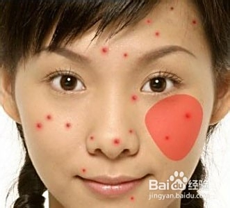 青春期長(zhǎng)痘痘了怎么消除，全面解析與應(yīng)對(duì)方法，青春期痘痘消除全面解析與應(yīng)對(duì)方法指南