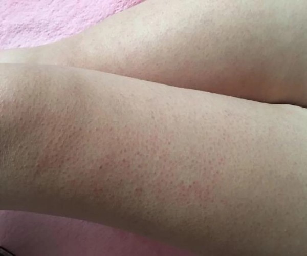 去除雞皮膚的小妙招，讓你的肌膚煥發(fā)自然光彩，雞皮膚改善秘訣，輕松告別不光滑，肌膚煥發(fā)自然光彩小妙招