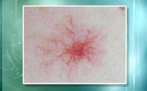 肝癌身上出現(xiàn)紅點圖片，癥狀解析與關注，肝癌身上紅點解析，癥狀、圖片及關注重點