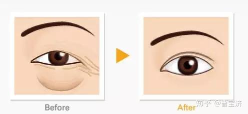 尋找最佳的眼袋治療醫(yī)院，專業(yè)解析與推薦，專業(yè)解析眼袋治療醫(yī)院推薦，助您尋找最佳治療機構(gòu)