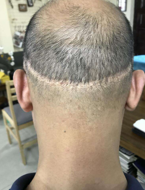 植發(fā)效果的持久性，能否長期維持與多種因素相關(guān)，植發(fā)效果的持久性與多種因素關(guān)聯(lián)，長期維持探討