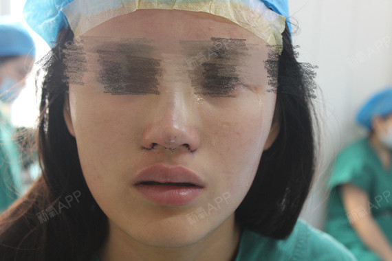 不動(dòng)手術(shù)縮小鼻頭，自然方法與實(shí)用技巧，自然縮小鼻頭的方法與實(shí)用技巧分享