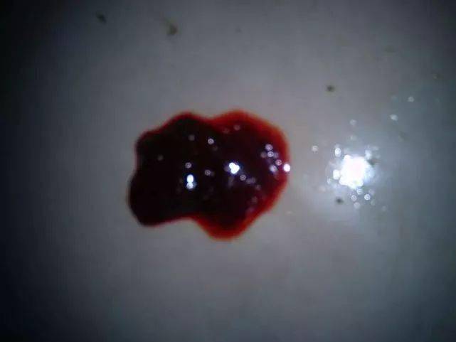 排便時(shí)出現(xiàn)撕裂感及出血，原因與應(yīng)對(duì)措施，排便疼痛撕裂感及出血，原因分析及應(yīng)對(duì)方法