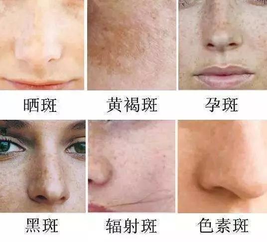 如何有效去除臉上斑點(diǎn)——全方位指南，全方位指南，如何有效去除臉上斑點(diǎn)