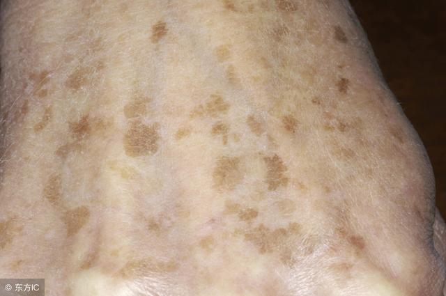 老年斑的形成原因及消除方法，老年斑的形成原因與消除方法全解析