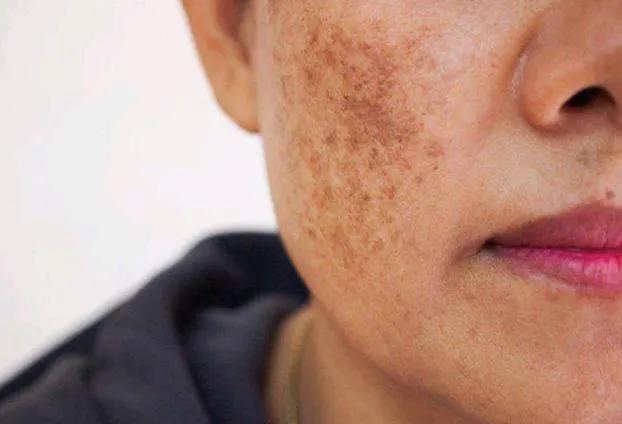 最簡單除老年斑的偏方，最簡單有效的老年斑去除偏方