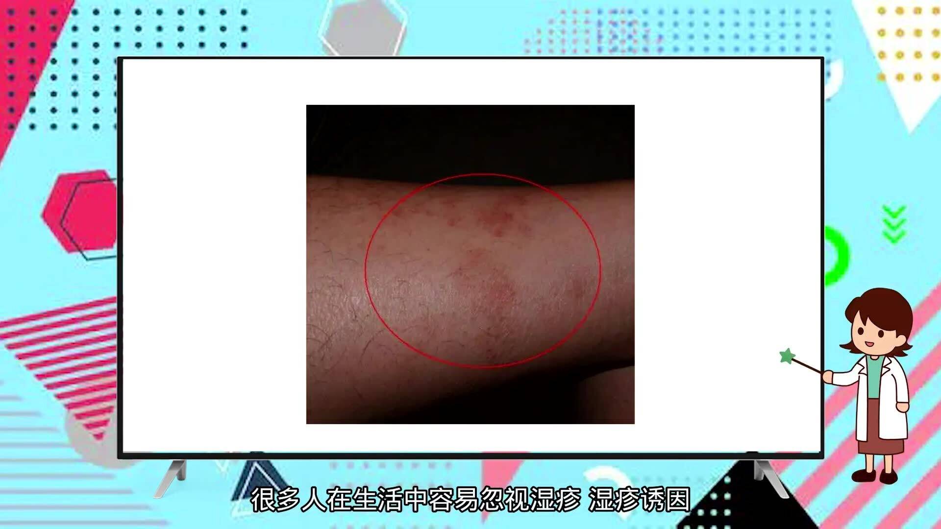 蕁麻疹夜晚止癢妙招，讓你遠(yuǎn)離瘙癢困擾，蕁麻疹夜晚止癢小妙招，告別瘙癢煩惱