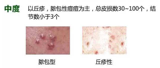 白頭粉刺圖片，了解、預(yù)防與應(yīng)對(duì)，白頭粉刺詳解，圖片、預(yù)防與應(yīng)對(duì)策略