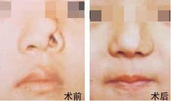 鼻整形手術費用詳解，多少錢？一切因素告訴你！，鼻整形手術費用全面解析，價格因素一網(wǎng)打盡！