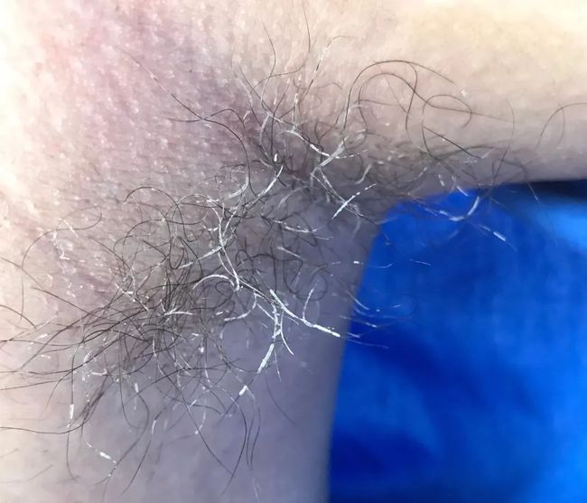 假性狐臭和狐臭的區(qū)別，假性狐臭與狐臭的差異解析