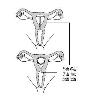 帶環(huán)與不帶環(huán)同房的差異，深度解析兩種方式的異同，帶環(huán)與不帶環(huán)同房的差異性解析，深度對比兩種方式的異同